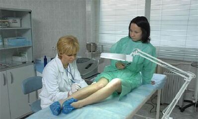 cum să tratezi venele varicoase de pe picioare