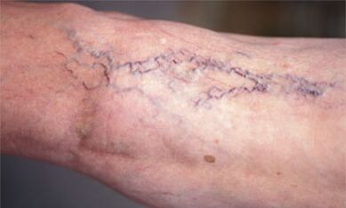 metode de tratare a venelor varicoase de pe picioare