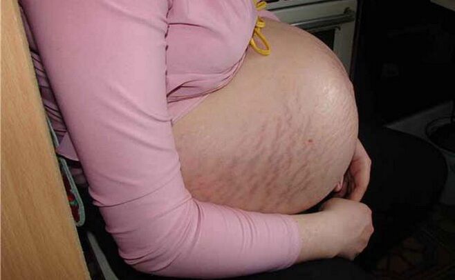 cauzele venelor varicoase în timpul sarcinii