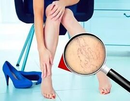 Simptomele depind de natura și stadiul venelor varicoase