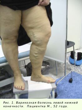 Venele varicoase trebuie tratate pentru a opri procesul