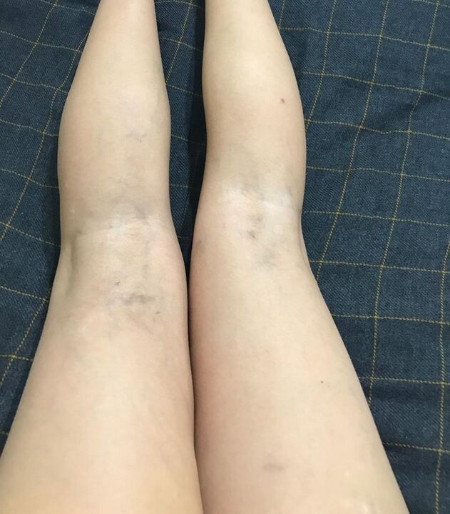 manifestări ale venelor varicoase la nivelul picioarelor